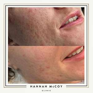 DOES MICRONEEDING HURT