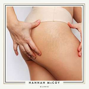 MICRONEEDLING FOR STRETCH MARKS