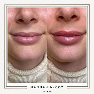 HOW LONG DOES LIP FILLER LAST