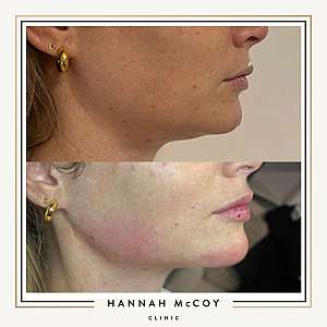 HOW TO GET A BETTER JAWLINE WITHOUT SURGERY