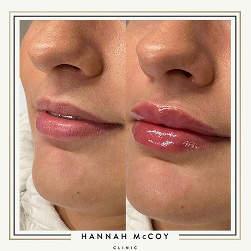 Lip Filler before and After 5