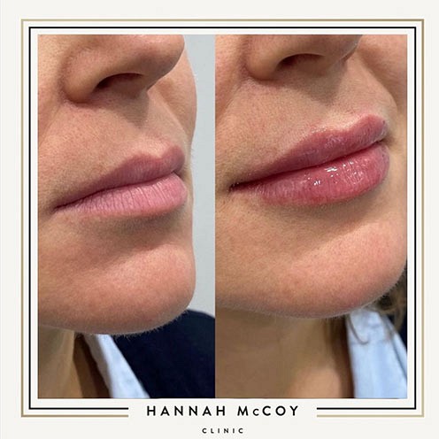 Lip Filler before and After 2