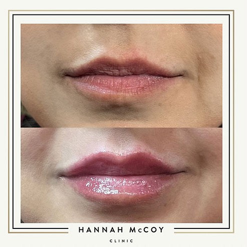 Lip Filler before and After 1